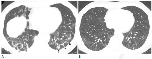 Organizing pneumonia pattern after COVID-19 infection in 64-year-old man. (A) CT obtained four months after infection onset shows patchy ground glass abnormality with bilateral peri-lobular thickening (arrows). (B) CT obtained three months later shows near complete resolution, with mild residual ground glass and linear abnormality. The patient had mild residual pulmonary symptoms.