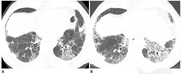 Progressive fibrosis following COVID-19 in 64-year-old man. The patient had a relatively mild COVID-19 infection which did not require intensive care unit (ICU) care, but subsequently developed progressive shortness of breath. (A) CT obtained six weeks after infection shows moderately extensive reticular abnormality with traction bronchiectasis. (B) CT obtained six months later shows progressive reticular abnormality and traction bronchiectasis. The patient had progressive shortness of breath and physiologic impairment.