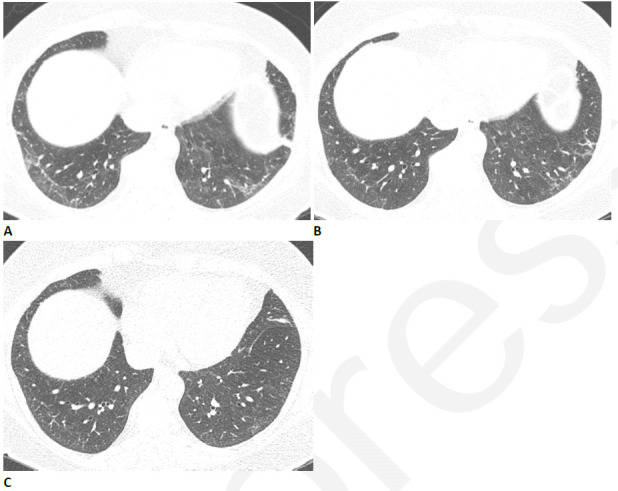 Resolving reticular abnormality and subpleural bands following COVID-related acute respiratory distress syndrome (ARDS). (A) CT two months after infection shows ground glass abnormality with mild reticular abnormality and subpleural bands. No traction bronchiectasis or architectural distortion is visible. (B) CT six months after infection shows partial clearing. (C) CT eleven months after infection shows near complete resolution, with mild residual ground glass abnormality. Pulmonary function returned to normal.