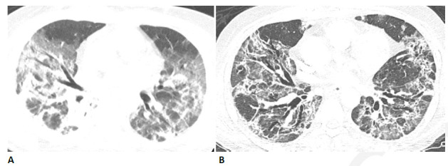 54-year-old man with COVID-related acute respiratory distress syndrome (ARDS) and subsequent fibrosis. (A) CT two weeks after admission shows diffuse ground glass abnormality with reticular abnormality and traction bronchiectasis in the right middle lobe indicating an organizing phase of lung injury. (B) CT six months after admission shows decreased ground glass abnormality but extensive traction bronchiectasis and architectural distortion suggesting fibrosis. The patient remained symptomatic with restricted pulmonary function.