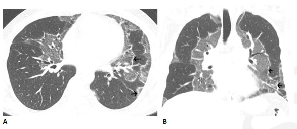 Organizing pneumonia pattern with atoll sign following COVID-19. (A, B) Axial and coronal CT images show multiple areas of sharply demarcated ground glass abnormality with thin peripheral rim (arrows).