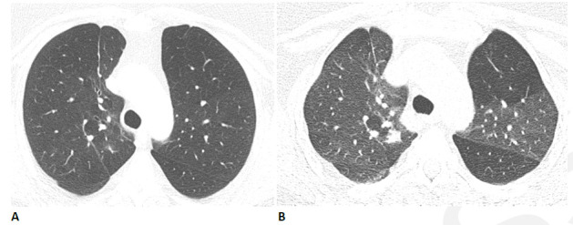 Obstructive lung disease after COVID-19 in a 60-year-old woman. (A) Inspiratory CT with persistent shortness of breath and chest tightness eight months following COVID-19 infection shows subtle mosaic attenuation, best seen in the anterior left upper lobe. (B) Expiratory CT confirms lobular air trapping, which was present on multiple images, indicating small airway obstruction.