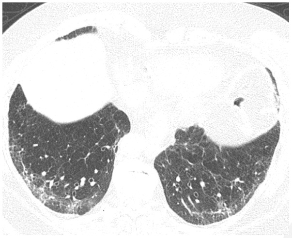 Post-COVID fibrosis in a 79-year-old woman. CT obtained three months after acute infection with acute respiratory distress syndrome (ARDS) shows reticular abnormality with traction bronchiectasis. Mild patchy ground glass abnormality is also present. The findings were new from a pre-COVID-19 CT scan, and the patient had persistent exertional dyspnea.