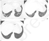 59-year-old woman with sequelae of COVID-related acute respiratory
distress syndrome (ARDS). (A) CT on admission shows patchy consolidation and
ground glass abnormality. This subsequently progressed to ARDS. (B) Two months
later, the consolidation has resolved but there is moderate ground glass
abnormality, multifocal linear abnormality and mild bronchiectasis. (C) Seven
months after admission, these abnormalities had almost completely resolved, and
restrictive pulmonary function also resolved.