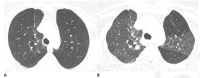 Obstructive lung disease after COVID-19 in a 60-year-old woman. (A)
Inspiratory CT with persistent shortness of breath and chest tightness eight
months following COVID-19 infection shows subtle mosaic attenuation, best
seen in the anterior left upper lobe. (B) Expiratory CT confirms lobular air
trapping, which was present on multiple images, indicating small airway
obstruction.