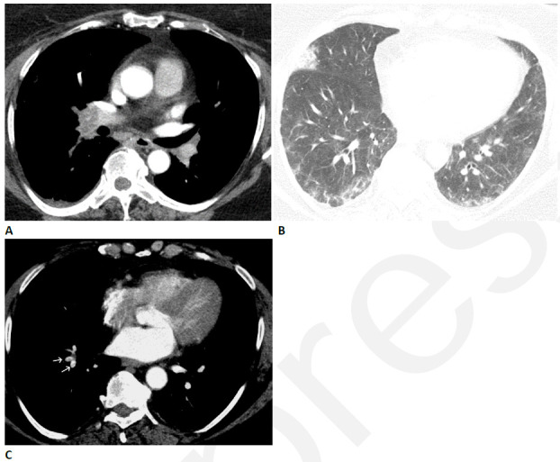 Pulmonary vascular disease after COVID-19 in a 63-year-old woman. (A) CT pulmonary arteriogram with persistent shortness of breath and elevated d-Dimer, seven weeks after onset of infection, shows obstructive thrombus in right interlobar pulmonary artery. (B) CT with lung windows at a lower level shows patchy ground glass opacity, and a focal wedge-shaped consolidative abnormality in the right middle lobe typical for pulmonary infarct. (C) Three months later, the large central thrombus had resolved, but nonocclusive linear webs were present in segmental vessels (arrows), typical for chronic thromboembolic disease.