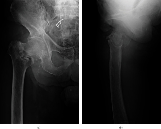 Medial Pelvic Migration of the Lag Screw after Intramedullary Nailing ...