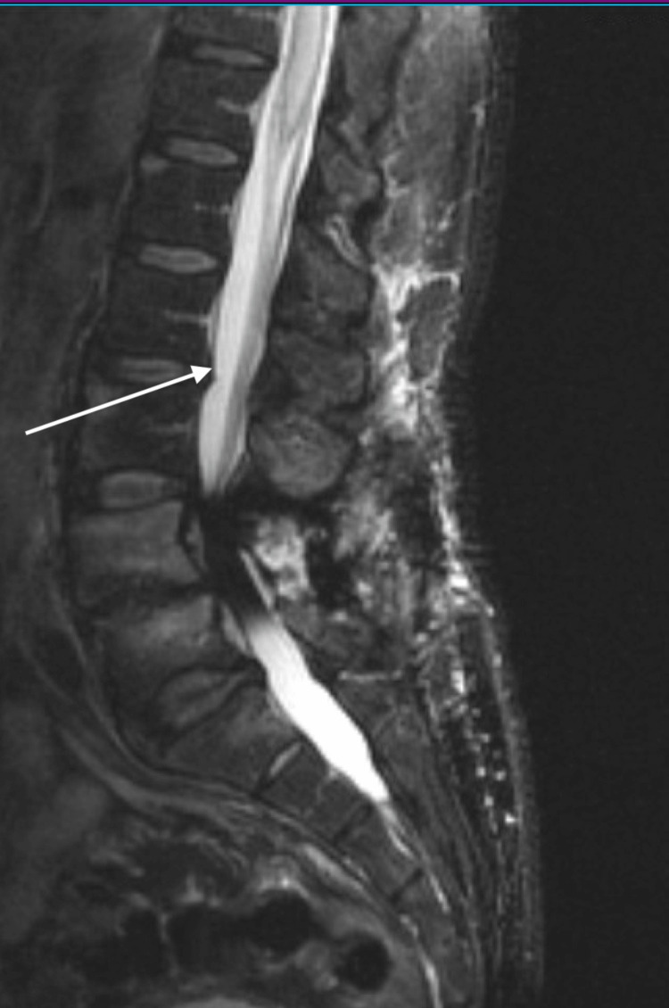 Crack Cocaine Use-related Spinal Cord Infarct - Pmc