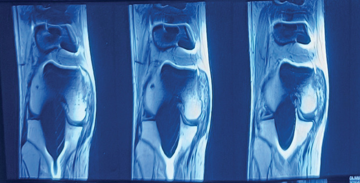 Breaking Free from Knee Pain: A Surgical Triumph in Managing Pellegrini ...