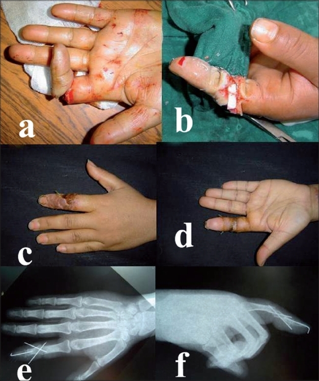 Finger avulsion injuries: A report of four cases - PMC