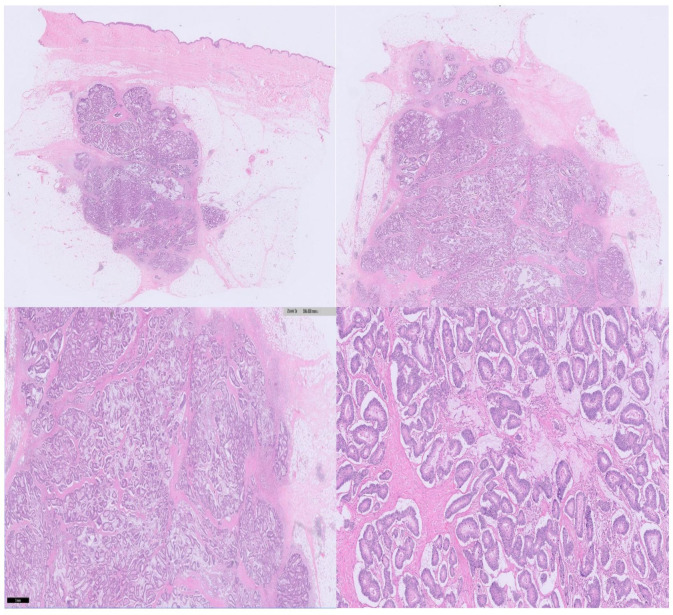 Appendiceal Adenocarcinoma With Breast Metastases - Pmc