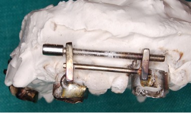 Figure 2: Soldered Distraction Device.