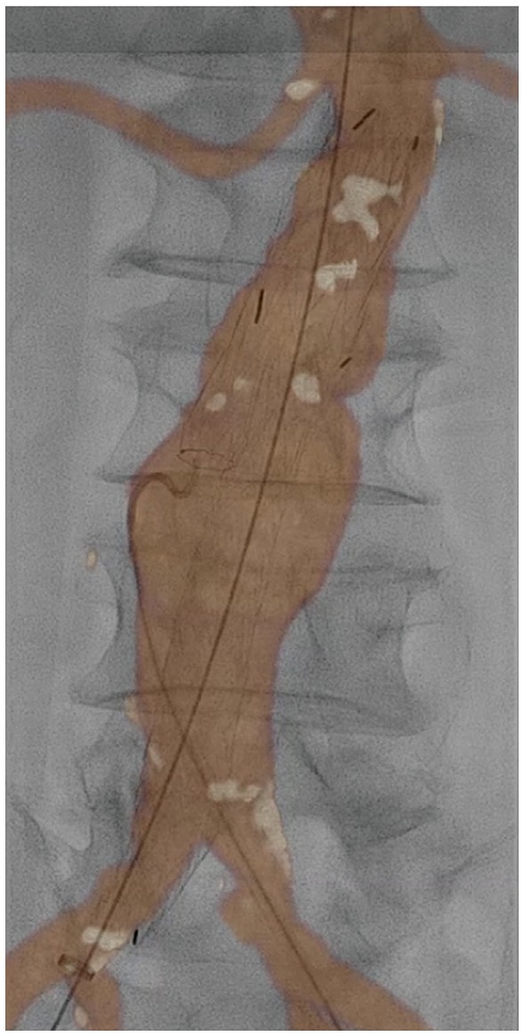 Endovascular Aneurysm Repair for Abdominal Aortic Aneurysm: A ...