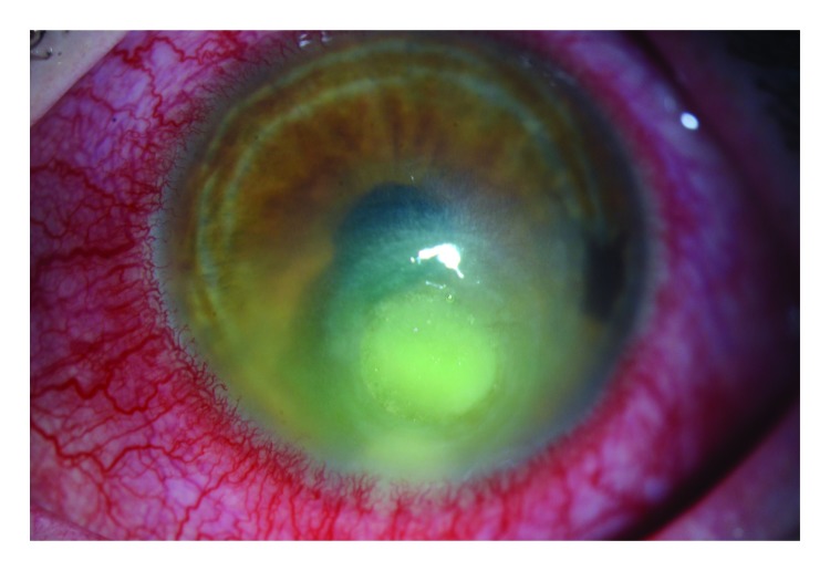 The figure above is a photo that shows findings characteristic of a contact lens–related corneal infection.