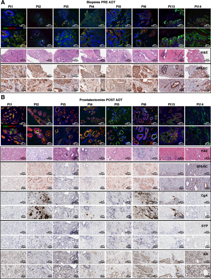 Figure 8. Stromal SPARC loss after ADT correlates with NED in patients with human prostate cancer. Immunofluorescence for GRP78 (red) and DAPI (blue), hematoxylin and eosin (H&E) staining, and IHC for SPARC, CgA, SYP, and AR in biopsies collected pretreatment (A) and in prostatectomies obtained post-treatment (B) from patients with prostate cancer undergoing neoadjuvant ADT. Except for hematoxylin and eosin staining (provided at ×200 magnification only), for each staining we provide both ×200 magnification (top) and ×400 magnification of the same area (bottom).