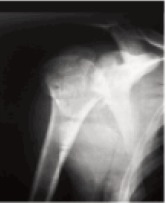 Fig. 2a: Preoperative radiograph of proximal humerus
fracture in Group 2.