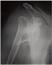 Fig. 1a: Preoperative (A)
radiograph showing 3 part fracture of proximal humerus.