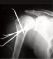 Fig. 2b: Postoperative radiograph of fracture
following K-wire fixation.