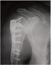 Fig. 1b: Postoperative radiograph (B)
showing fixation offracture with PHILOS plate.