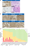 Figure 1. IHC analysis of B7-H3 expression on human tumor tissues. A, Representative B7-H3 expression pattern in TMA tissue by B7-H3 IHC and image of hematoxylin and eosin (H&E) staining. Esophageal cancer (top) and normal esophagus tissue adjacent to tumor (bottom). Arrow, vasculature/endothelium; arrowhead, fibrous stromal cells; asterisk, basal cells. Scale bar, 100 μm. B, Representative B7-H3 IHC images of human tumor tissues. Scale bar, 100 μm. C, B7-H3 expression on various human solid tumors. B7-H3 IHC analysis was performed using TMAs. H-score of B7-H3 expression on tumor cells in each sample was calculated. Number in parentheses indicates the number of samples. Ad, adenocarcinoma; ca, cancer; Endomet, endometrial; Eso, esophageal cancer; HCC, hepatocellular carcinoma; HNSCC, head and neck squamous cell carcinoma; N, nontumor epithelium; RCC, renal cell carcinoma; Sq, squamous; T, tumor cells.