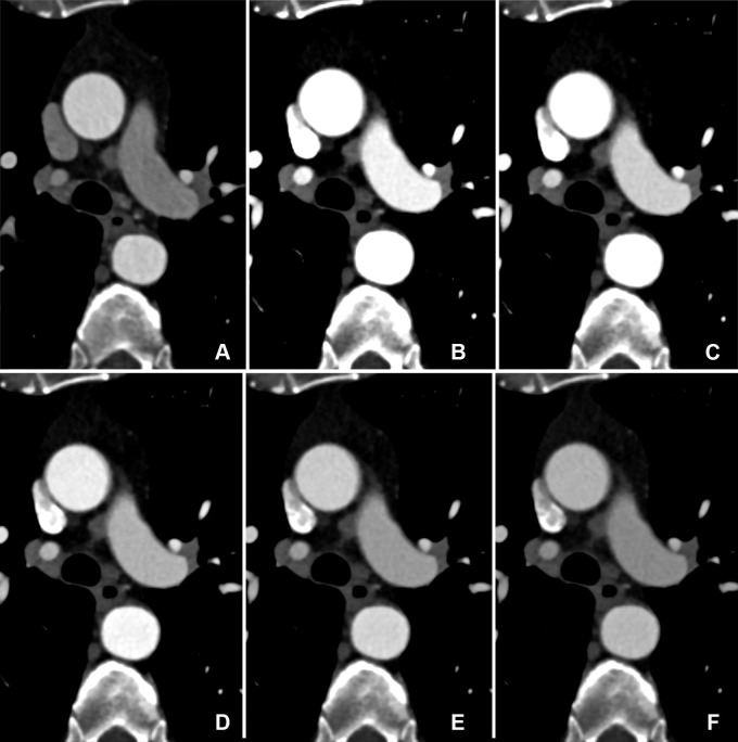 Comparison of image quality between EID CT and PCD CT using identical contrast media protocol and matched radiation dose. Transverse CTA images show the thoracic aorta at the level of the pulmonary trunk in a 62-year-old man in group 1, shown using identical window settings (window center: 350 HU, window width: 1000 HU). (A) Images from scans performed with a third-generation dual-source CT system with EIDs. Images were reconstructed with a section thickness of 2 mm. The automated tube voltage selection algorithm selected 80 kVp. BMI, effective diameter, CTDIvol, and SSDE were 24.2 kg/m2, 293 mm, 3.02 mGy, and 3.87 mGy, respectively. (B–F) Images from PCD CT with VMI at energy levels from 40 to 60 keV (B: 40 keV, C: 45 keV, D: 50 keV, E: 55 keV, F: 60 keV). Time interval between scans was 11 months. Mean BMI, effective diameter, CTDIvol, and SSDE at the time of the second scan were 25.3 kg/m2, 295 mm, 3.05 mGy, and 3.90 mGy, respectively. Both scans were performed with the same contrast media protocol (volume, 70 mL). Note the higher vessel attenuation at lower energy levels for PCD CT. BMI = body mass index, CTA = CT angiography, CTDIvol = volume CT dose index, EID = energy-integrating detector, PCD = photon-counting detector, SSDE = size-specific dose estimate, VMI = virtual monoenergetic images.