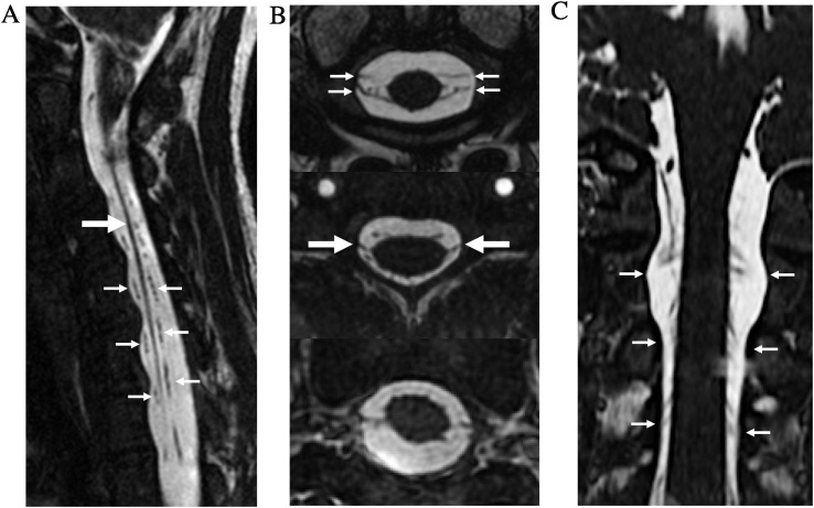 Practical applications of CISS MRI in spine imaging - PMC