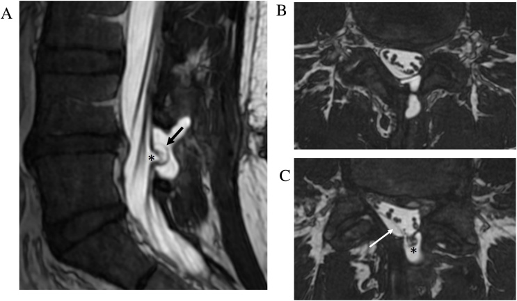 Practical applications of CISS MRI in spine imaging - PMC