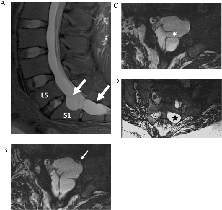 Practical applications of CISS MRI in spine imaging - PMC