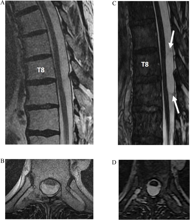 Practical applications of CISS MRI in spine imaging - PMC