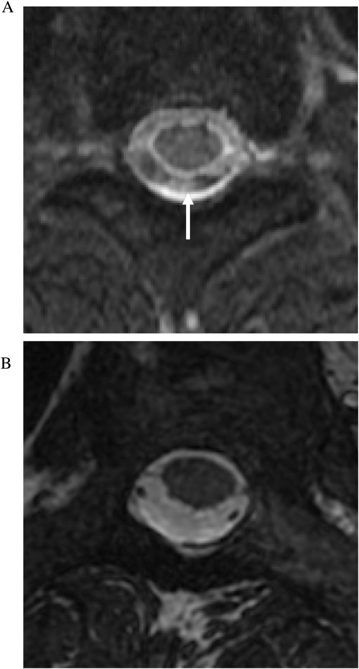 Practical applications of CISS MRI in spine imaging - PMC