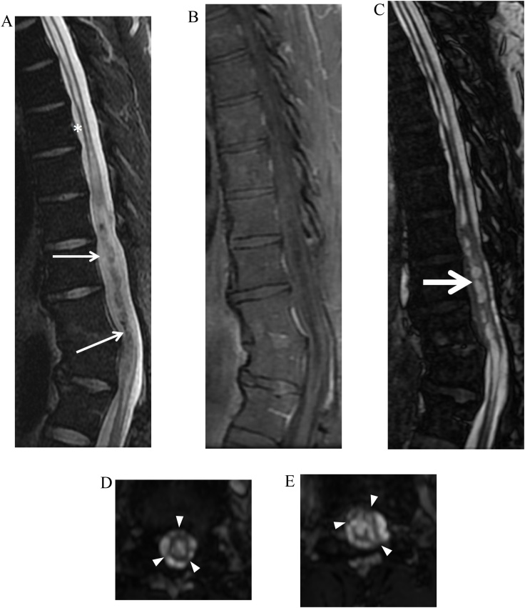 Practical applications of CISS MRI in spine imaging - PMC