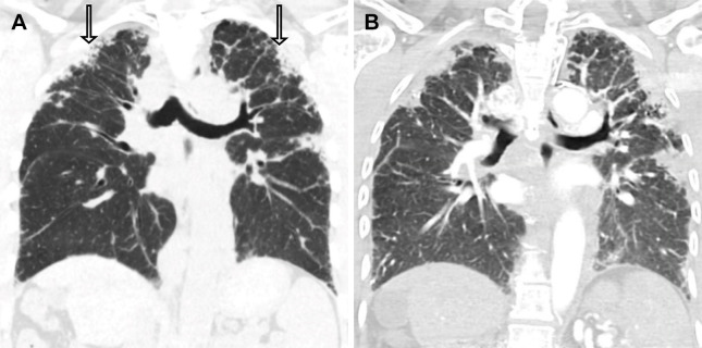 Thin-Section CT in the Categorization and Management of Pulmonary ...