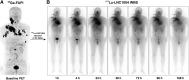 Figure 1. A representative example of a patient who underwent 177Lu-LNC1004 therapy. A, A 36-year-old man with progressive metastatic radioiodine-refractory differentiated thyroid cancer began treatment with multi-kinase inhibitors but still experienced disease progression. 68Ga-FAPI-46 PET/CT was performed for patient screening before 177Lu-LNC1004 therapy and revealed intense 68Ga-FAPI-46 uptake in metastatic lesions. B, After administrating 3.33 GBq of 177Lu-LNC1004, intense radiotracer uptake was observed in the metastatic lesions (arrows) on post-therapeutic whole-body scintigraphy (WBS; anterior views) from 1 to 168 hours after injection, which was consistent with 68Ga-FAPI-46 uptake presented in the PET/CT.