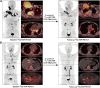 Figure 3. Two representative patients with a favorable therapeutic response after 2 cycles of 177Lu-LNC1004. A, A 36-year-old man with disease progression after TKI treatment received 177Lu-LNC1004 RLT at 3.3 GBq/cycle. Baseline 68Ga-FAPI-46 PET/CT revealed intense 68Ga-FAPI-46 uptake in most metastatic lesions, including lymph node, vertebral, and clavicular metastases (left, arrows). Obstructive pneumonia was also observed in the left lung due to the enlarged lymph nodes. After 2 treatment cycles, restaging 68Ga-FAPI-46 PET/CT revealed a significant reduction in tumor size and radiotracer uptake in most of the metastatic lesions (right, arrows). Furthermore, the non-target lesion of obstructive pneumonia resolved. B, A 42-year-old man with disease progression after TKI treatment underwent 177Lu-LNC1004 therapy. Baseline 68Ga-FAPI-46 demonstrated intense uptake in multiple bone metastases, left hilar lymph node, and liver metastases (left, arrows). Follow-up 68Ga-FAPI-46 PET/CT revealed a significant reduction in tumor size and radiotracer uptake in these metastatic lesions (right, arrows) after 2 cycles of 177Lu-LNC1004 therapy.