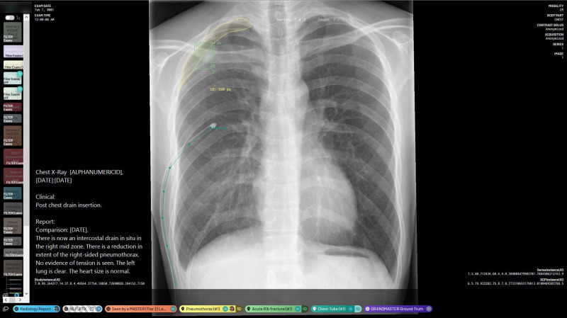 Annotation platform interface and example annotations. This image shows a chest radiograph that has segmented annotations of a right apical pneumothorax, a single acute rib fracture, and one intercostal chest tube. It also features the image’s fully anonymized Digital Imaging and Communications in Medicine metadata and radiology report. The “NLP_PTX” label indicates that the report-based classification algorithm gives this image a preliminary “pneumothorax-positive” classification. There are also global image-level annotations indicating that this image has been reviewed by both a tier 2 annotator and a tier 3 annotator. NLP_PTX = natural language processing–determined pneumothorax presence.