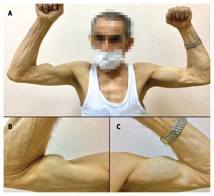 “Popeye deformity” associated with proximal biceps tendon rupture - PMC