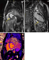Cardiac MR images in a 21-year-old male patient with filamin C
variant–associated cardiomyopathy. Postcontrast T1-weighted images acquired
with a 1.5-T MRI scanner in (A) short-axis view and (B) vertical long-axis view
demonstrate marked concentric (or “ringlike”) midmyocardial late
gadolinium enhancement of the left ventricle (yellow arrows). (C) Native T1 mapping
image in short-axis view demonstrates an elevated T1 value (1120 msec).