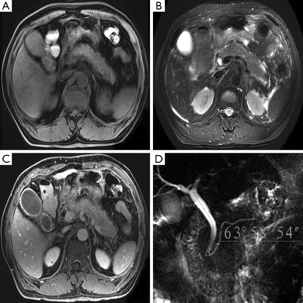 The angle of pancreaticobiliary junction correlates with acute ...