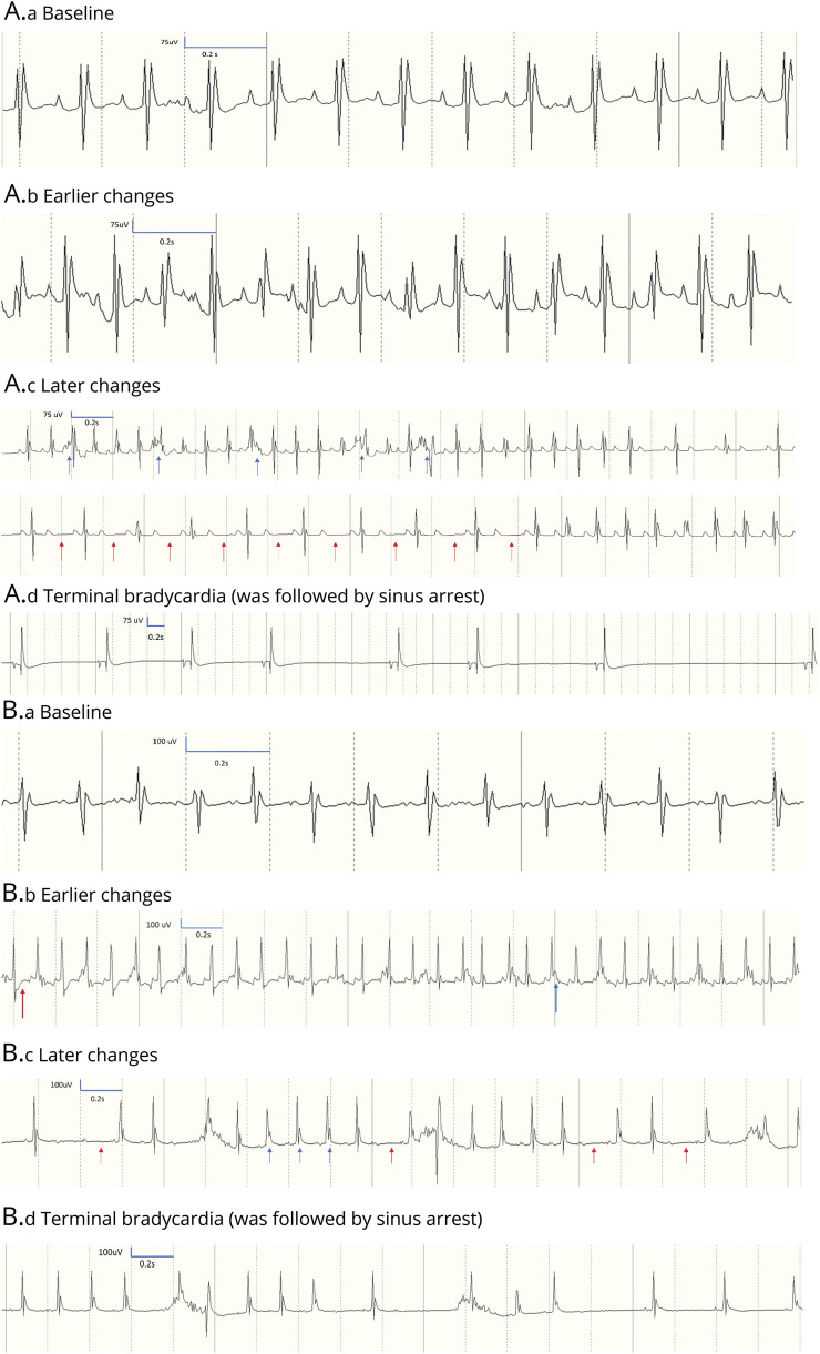 Cardiac phenotype in ATP1A3-related syndromes: A multicenter cohort ...