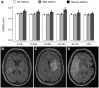 The content is about a medical study on cerebral edema in stroke patients, and the alt text for the image should describe a scientific figure. Here is an appropriate alt text for the image provided: Longitudinal optical coherence tomography imaging shows the effects of mild-to-moderate and severe cerebral edema after stroke over time.