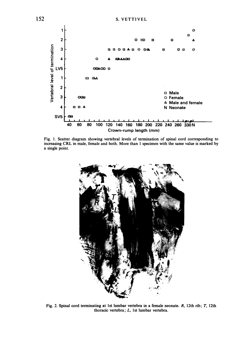 Vertebral level of the termination of the spinal cord in human fetuses ...