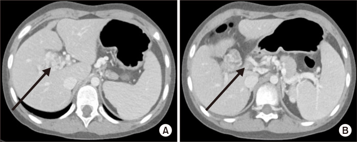 Standard or Variant Meso-Rex Shunts for Children with Variceal Bleeding ...