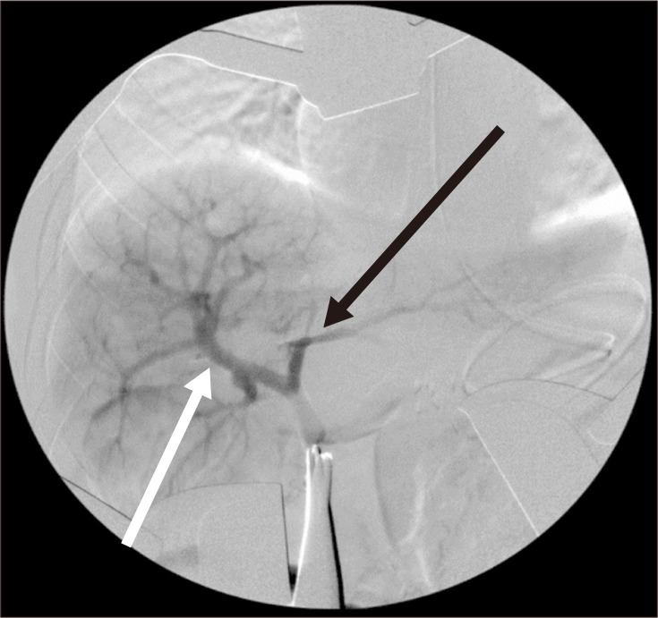 Standard or Variant Meso-Rex Shunts for Children with Variceal Bleeding ...