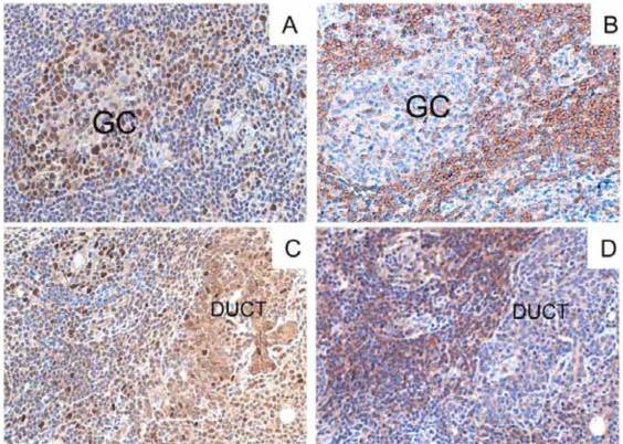 Fig. (2). BAFF and BAFF-R expression in parotid gland (MESA pre-rituximab in the Panel A and C, and MALT NHL postrituximab in the Panel B and D) during the follow-up.