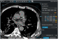CT annotations: Visual scoring of coronary artery calcifications. The coronary artery calcium score was evaluated according to the method by Shemesh et al. (13). Calcification in each of the four main coronary arteries (LM:left main, LAD:left anterior descending, LCX:circumflex, and RCA:right) was categorized as none, mild, moderate, or severe. Calcification was classified as mild when less than one-third of the length of the entire artery showed calcification, moderate when one-third to two-thirds of the artery showed calcification and severe when more than two-thirds of the artery showed calcification.