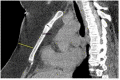 CT annotations: Measurement of chest wall fat. The amount of fat in the chest wall was measured as shown here, in front of the sternum, on a mid-sagittal reformation of noncontrast CT. Here it is clearly increased in an obese 57-year-old man. This annotation served as a substitute for BMI.