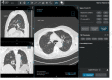 CT annotations: Classification as COVID+, COVID- or Normal CT. The readers had access to the CT scans using a 3D image visualization web application, allowing scrolling through the entire lung volume in the coronal, sagittal, or axial transverse plane. The CT scan shown here has been classified as COVID+, due to the presence of bilateral ground glass opacities and absence of features such as mucoid impaction, bronchiolar nodules, segmental or lobar consolidation.