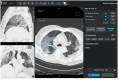 CT annotations: Visual quantification of lung disease extent. The readers had to visually quantify the extent of COVID-19 pneumonia on a 5-point scale. Here, it is estimated to be more than 50% and less than 75% (50-75%). Readers were also asked to manually contour COVID-19 pneumonia (area in blue in the right lung) on at least 2 CT images to later train deep learning algorithms for automated quantification of disease extent.