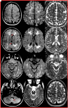 Figure 3. Magnetic resonance imaging of