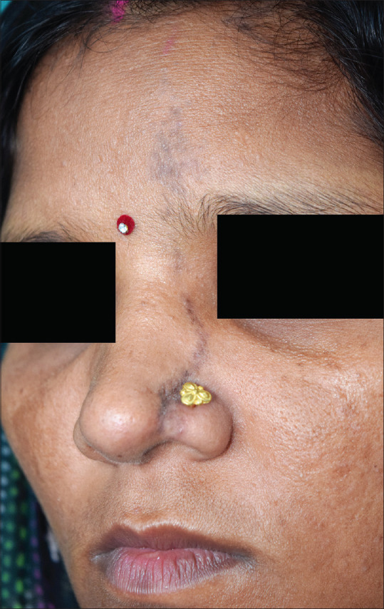 Linear Cutaneous Lupus Erythematosus